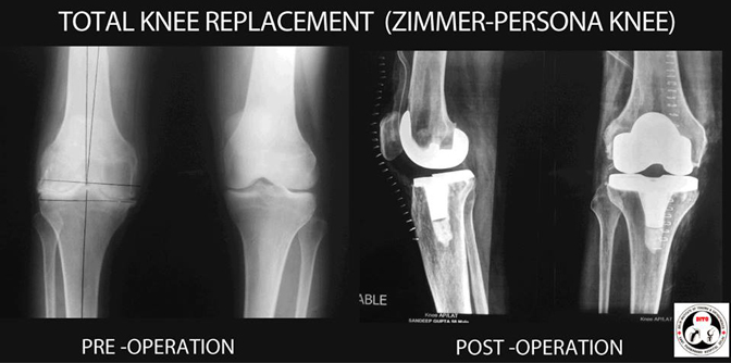 total-knee-replacement-zimmer-persona-knee