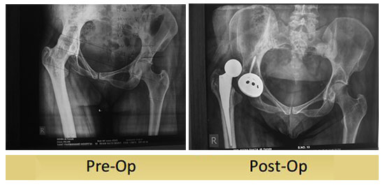 Uncemented Total Hip Replacement