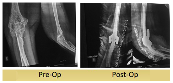 Total-Elbow-Replacement