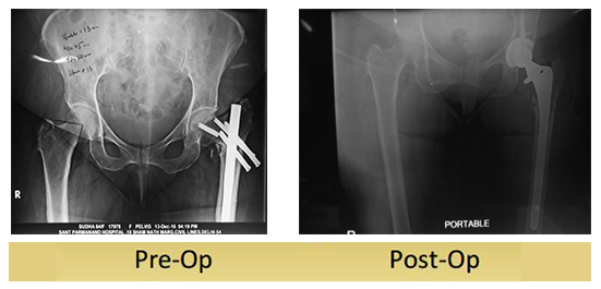 Primary-Complex-Total-Hip-Replacement-64yr-old-by-dr-shekhar-agarwal