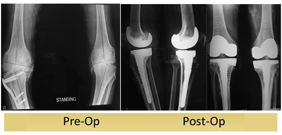 complex-primary-varus-knee-tkr-operated-by-dr-shekhar-agarwal