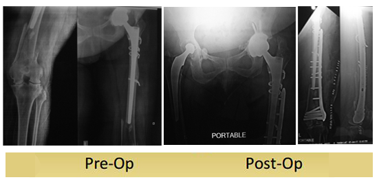 left-periprosthetic-femur-fracture-operated-by-dr-dshekhar-agarwal