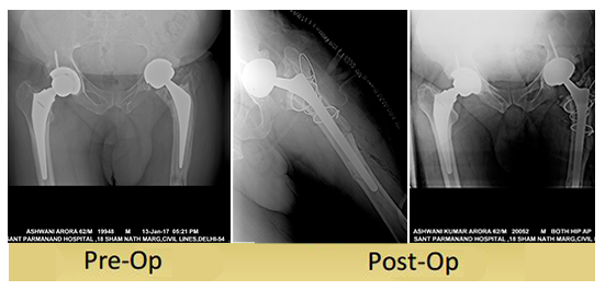 revision-total-hip-replacement-ashwani-arora-done-dr-shekharagarwal