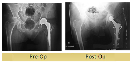 revision-total-hip-replacement-sudhesh