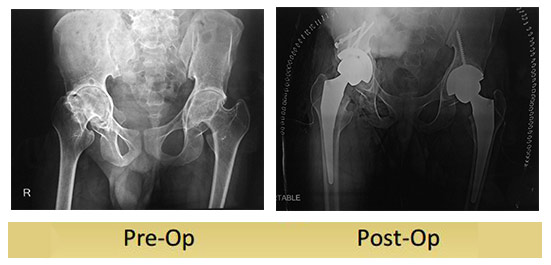 Bilateral-total-hip-replacement-done-by-dr-shekhar-agarwal