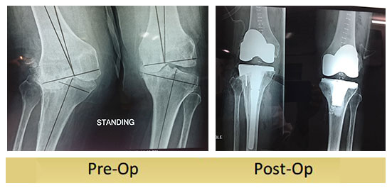 Valgus-knee-operated-by-dr-shekhar-agarwal
