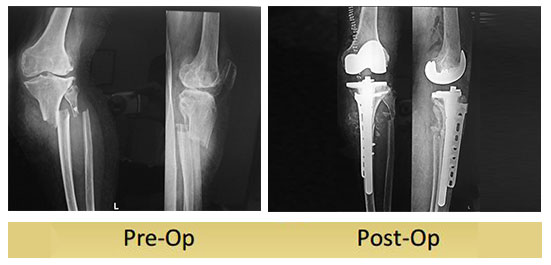 left-total-knee-replacement-done-by-dr-shekhar-agarwal