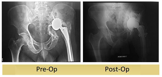 Revision-Total-Hip-Replacement-60-Year-old-gentleman