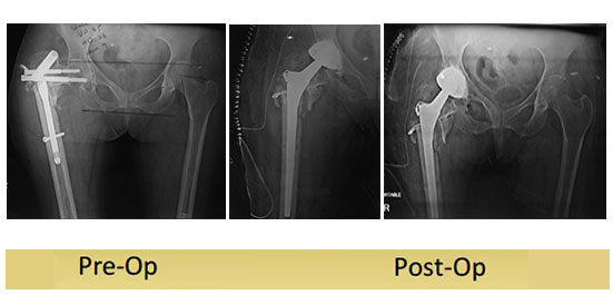 Revision-Total-Hip-Replacement-kamlesh