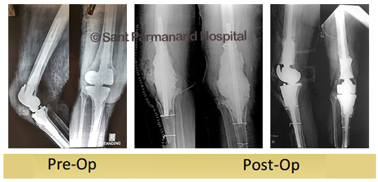 revision-total-knee-replacement-jayant