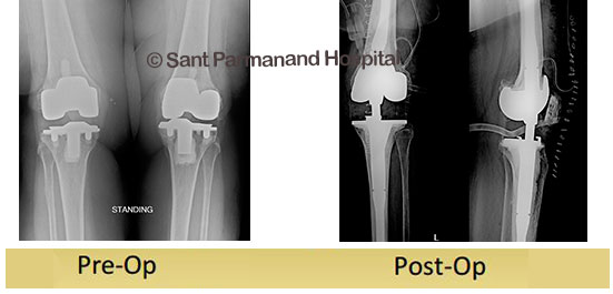 revision-total-knee-replacement