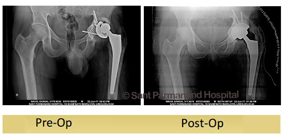 Total-Hip-Replacement-Revision-Acetabulum