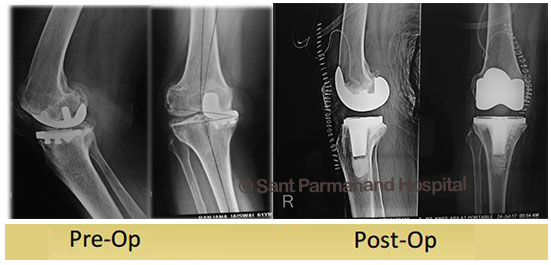 Uni-condylar-to-Total-Knee-Replacement