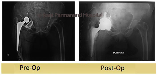 partial-hip-replacementdiabetic-and-hypertensive