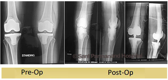 revision-knee-replacement-rotating-hinge