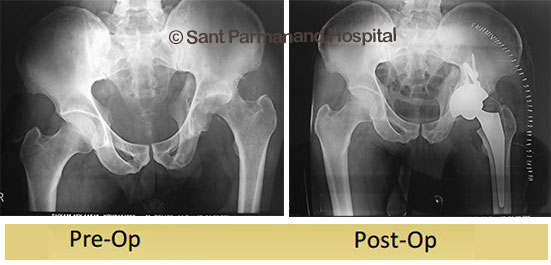 Acatabular-Fracture-to-total-hip-replacement