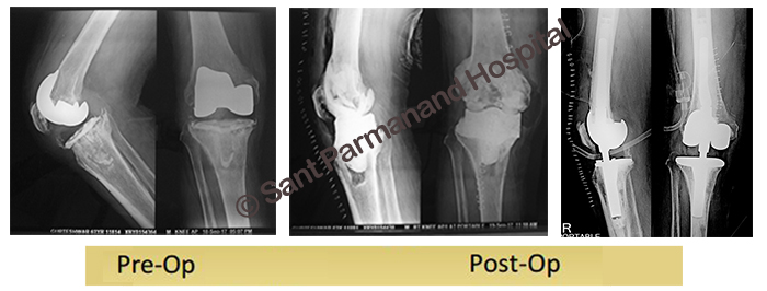 Two-stage-Revision-TKR-with-RHK-and-Stem-Extender-and-Metallic-Augment