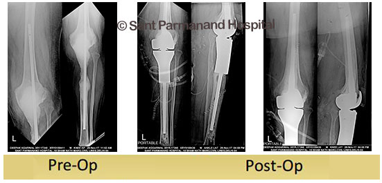 Revision Total Knee Replacement With Megaprosthesis Sant Parmanand