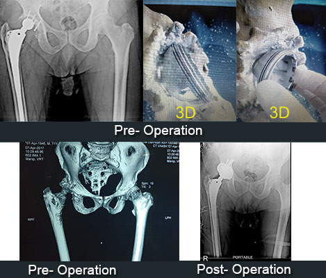 Re-Revision-Total-Hip-Replacement