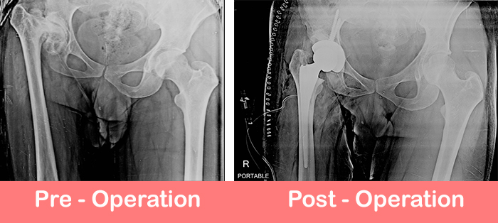 Dysplastic-Hip-surgery-by-dr-dr-shekhar-agarwal