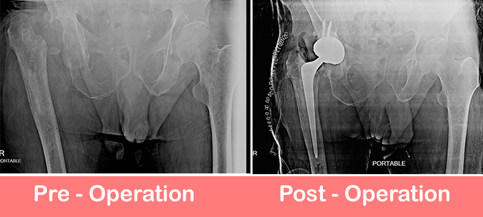 Total_Hip_Replacement-by-Dr-Shekhar-Agarwal