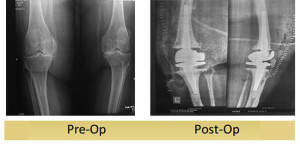 Revision Total Knee Replacement -Kanta-Gupta