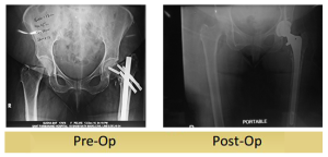 Primary-Complex-Total-Hip-Replacement-64yr-old-by-dr-shekhar-agarwal