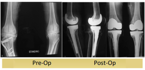 complex-primary-varus-knee-tkr-operated-by-dr-shekhar-agarwal