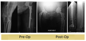 left-periprosthetic-femur-fracture-operated-by-dr-dshekhar-agarwal