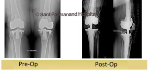 revision-total-knee-replacement-done-by-dr-shekhar-agarwal