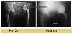 revision-total-knee-replacement-bela-sachdeva-done-by-dr-shekhar-agarwal