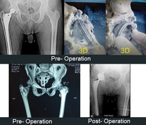 Re-Revision Total Hip Replacement