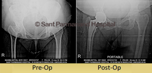 Total-Hip-Replacement-Dysplastic-Hip