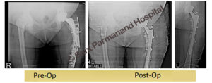 Revision Total Hip Replacement