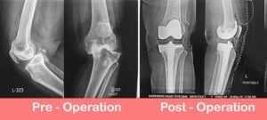 Complex Primary Varus Knee