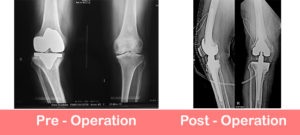 Revision-Total-Knee-Replacement