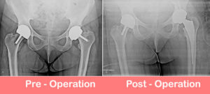 total-hip-replacement-by-dr-shekhar-agarwal