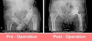 total-hip-replacement-by-dr-shekhar-agarwal-13-09-18