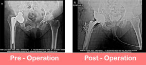 re-revision-total-hip-replacement-by-dr-shekhar-agarwal