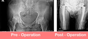 Bilateral-Total-HIp-Replacement-29-01-2019