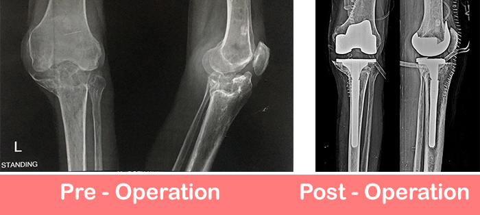 Primary-Complex-Knee