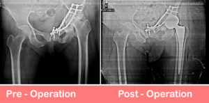 Total-Hip-Arthroplasty-Dual-Mobility