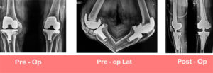 Revision-Total-Knee-Replacement