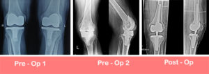 Revision Total Knee Replacement