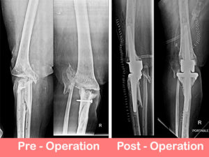 Post traumatic primary complex knee replacement