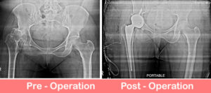 Dysplastic-Hip-Uncemented-Total-Hip-Replacement