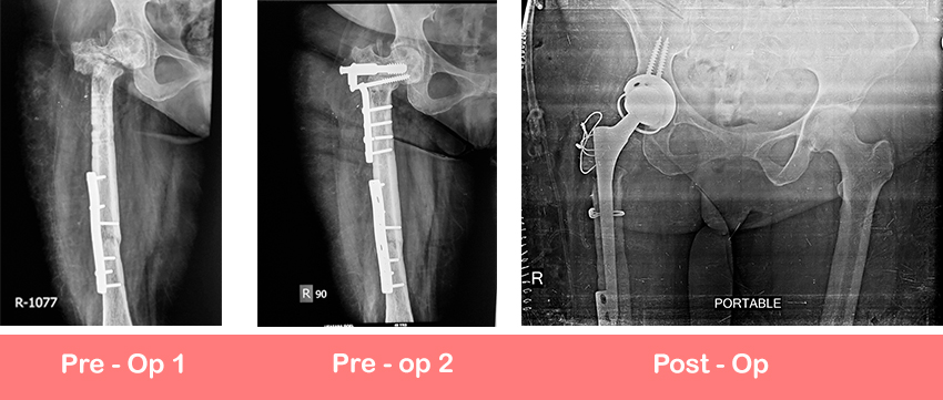 Uncemented dual mobility constrained cup with long stem Total Hip Replacement