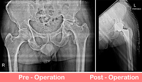 Deformity-Correction-And-Uncemented-Total-Hip-Replacement