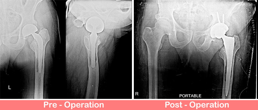 Uncemented Total Hip Replacement