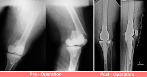 Distal Femur Replacement Surgery